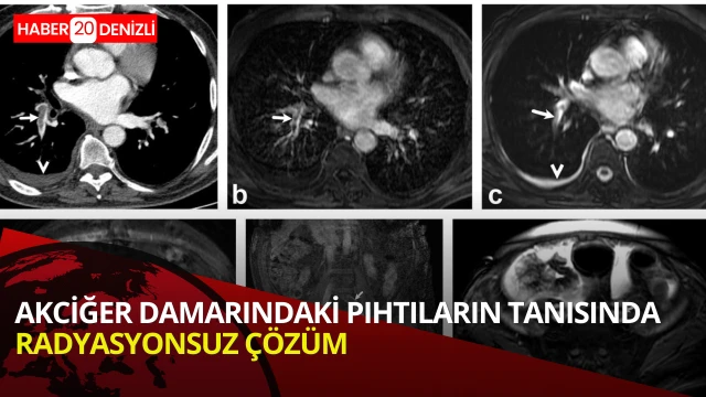 Akciğer damarındaki pıhtıların tanısında radyasyonsuz çözüm