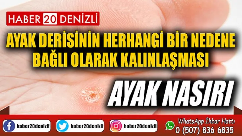 Ayak derisinin herhangi bir nedene bağlı olarak kalınlaşması: Ayak Nasırı