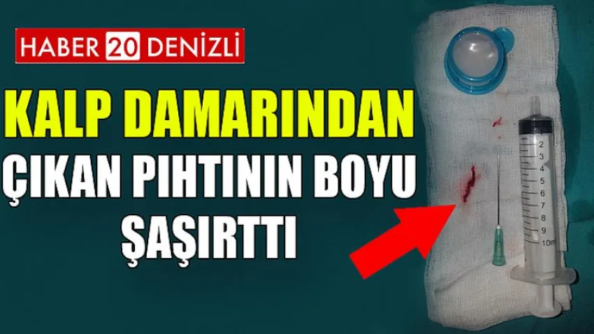 Kalp Damarından Çıkan Pıhtının Boyu Şaşırttı