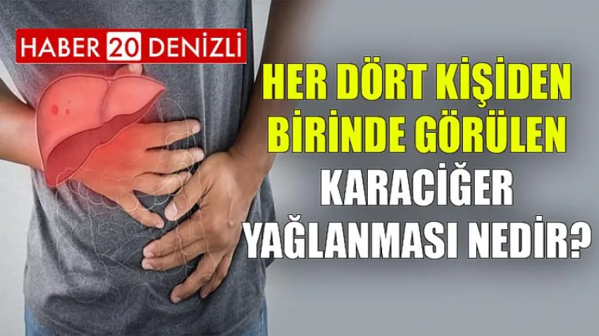 Her Dört Kişiden Birinde Görülen Karaciğer Yağlanması Nedir?