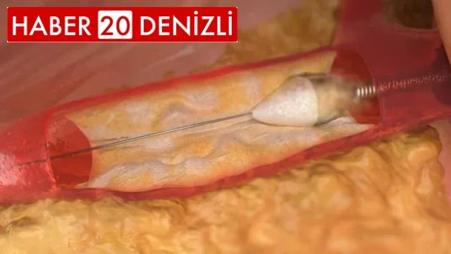 Kireçli kalp damarlarının açılmasında yeni teknoloji