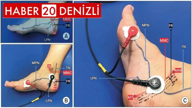 İdrar kaçırmada PAÜ Tıp Fakültesi’nden dünyada ilk