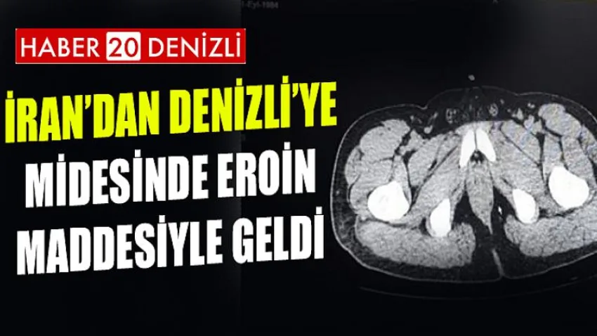 İran'dan Denizli'ye Midesinde Eroin Maddesiyle Geldi