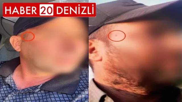 Jandarma korkusundan yüzündeki beni aldırdı