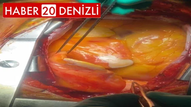 Kalpten beslenerek çevresini tamamen saran 1,1 kilogram yağ kitlesi görenleri hayrete düşürdü